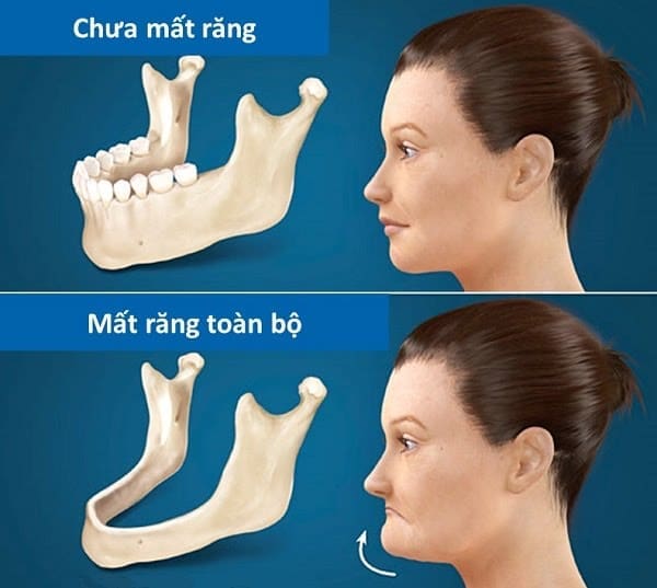 Người bị mất răng có thể làm tiêu xương hàm