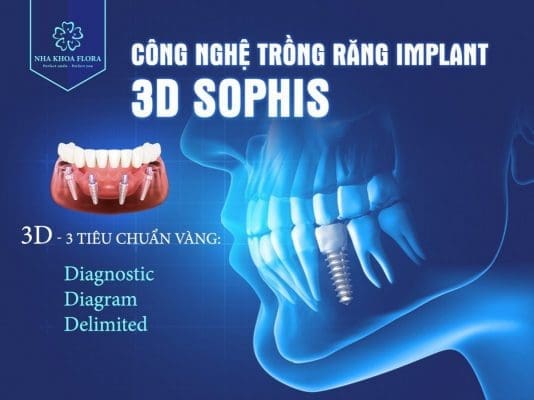 Công nghệ trồng răng Implant 3d Sophis tại nha khoa Flora 