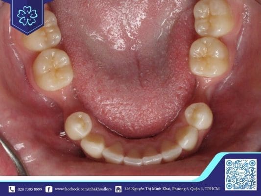 Mất răng lâu năm xuất hiện tình trạng tiêu xương (ảnh minh họa)