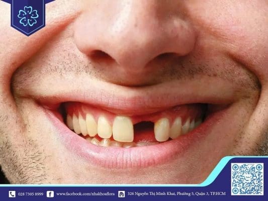 Mất răng lâu năm có trồng răng được không? (ảnh minh họa)