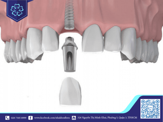 Trụ Implant tích hợp nhanh với xương hàm, rút ngắn quá trình trồng răng Implant lại không gây đau đớn (ảnh minh họa)