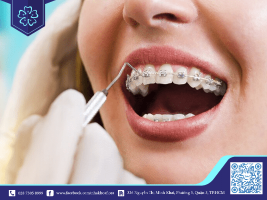 X quang niềng răng giúp đảm bảo kết quả niềng