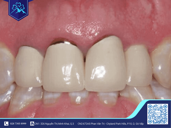Tình trạng bị tụt lợi do bọc răng sứ