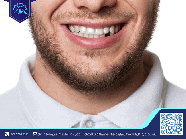 Tình trạng mất răng sớm là như thế nào?