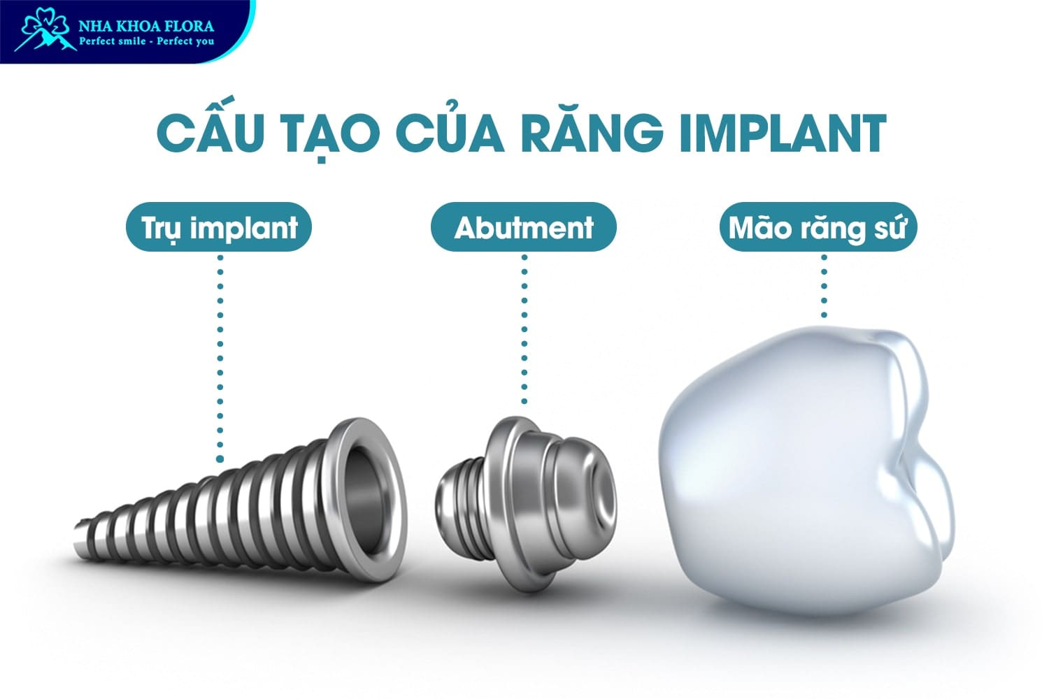 Trồng Răng Implant Là Gì? 10 Điều Cần Biết Trước Khi Thực Hiện - ảnh 2