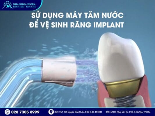 Cách vệ sinh răng Implant - ảnh 3